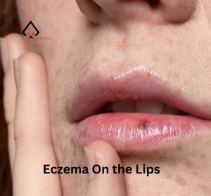 Eczema On Lips| Symptoms, Remedies & Precautions that You Need to Know.